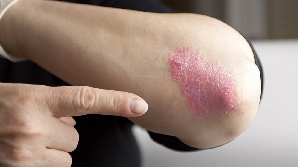Dia mundial da Psoríase: especialista alerta que doença não é contagiosa