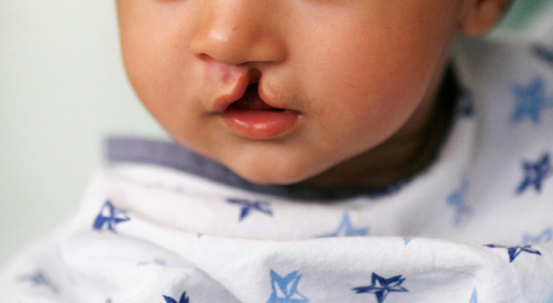 No AM, lei estabelece protocolo de atendimento a recém-nascidos com fissura labiopalatal